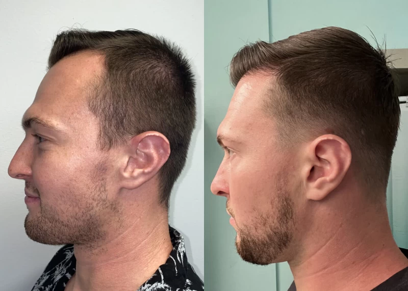 Patient p471 hair transplant before and after left view