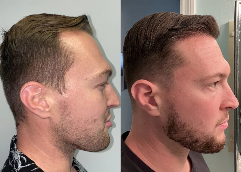Patient p471 hair transplant before and after right view
