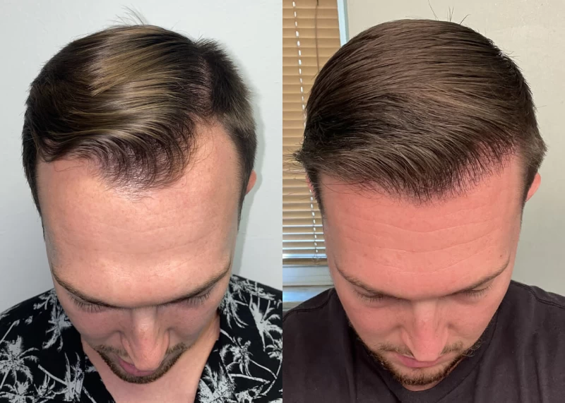 Patient p471 hair transplant before and after tilt view