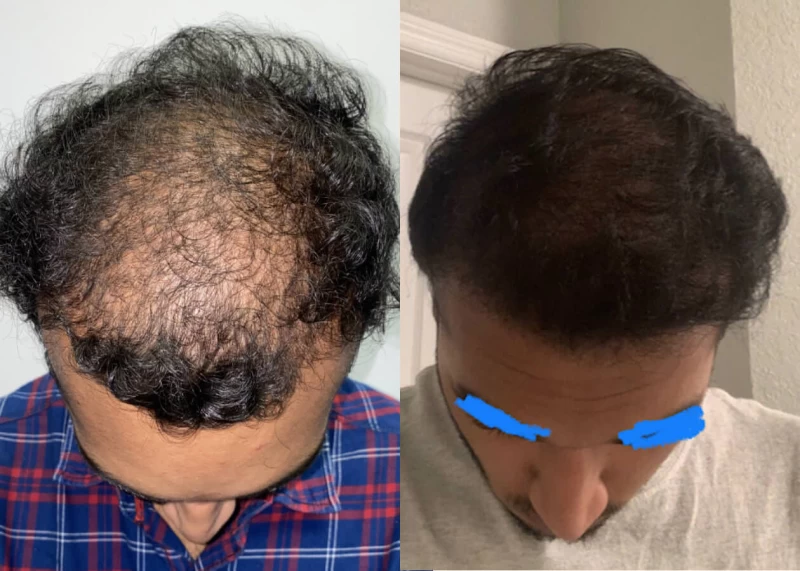 Mr.p472 Hair Transplant Before and After