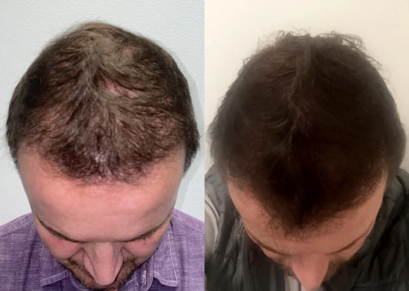 Mr.p473 Hair Transplant Before and After