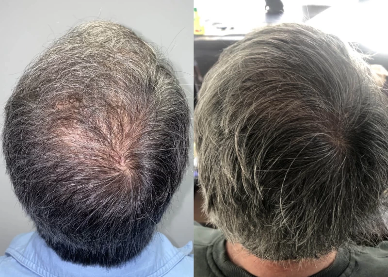 Patient p475 hair transplant before and after crown view