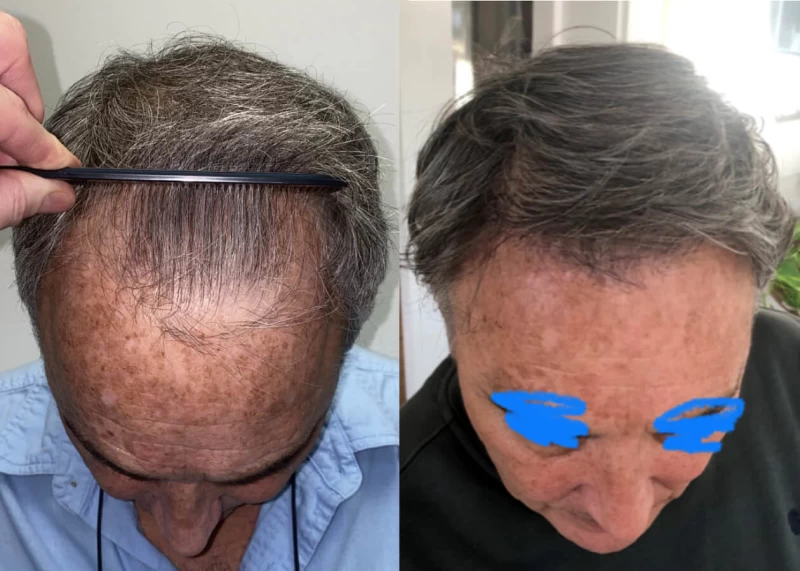 Mr.p475 Hair Transplant Before and After