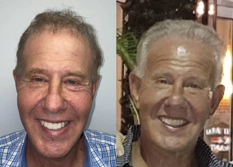 Mr.p476 Hair Transplant Before and After