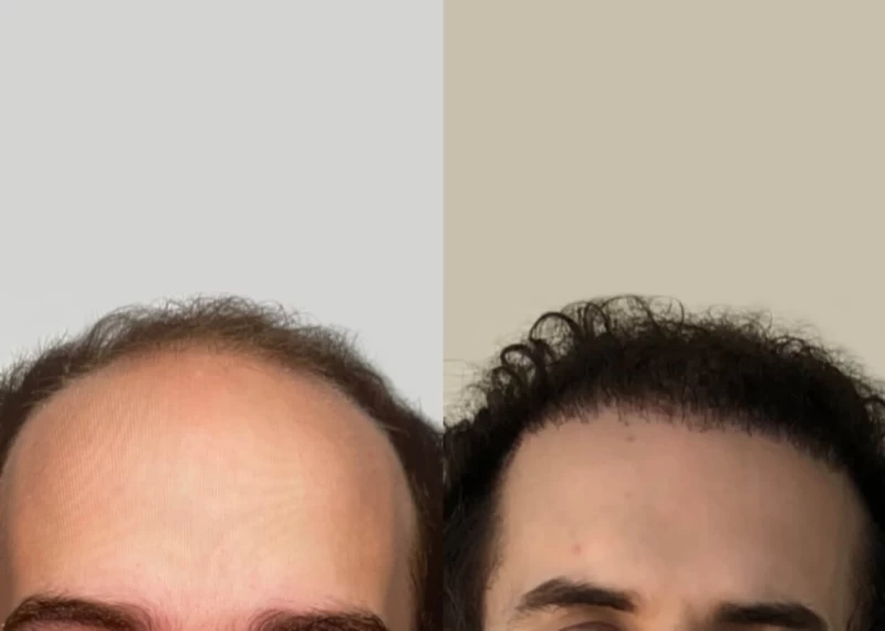 Mr.p477 Hair Transplant Before and After