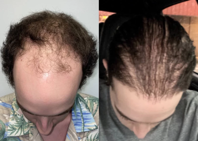 Patient p477 hair transplant before and after tilt view