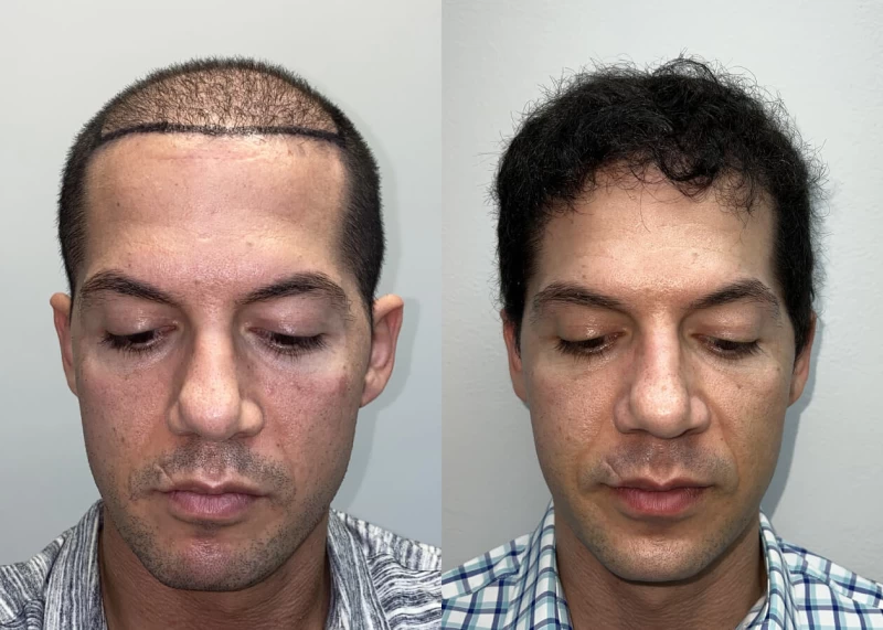 Mr.p478 Hair Transplant Before and After