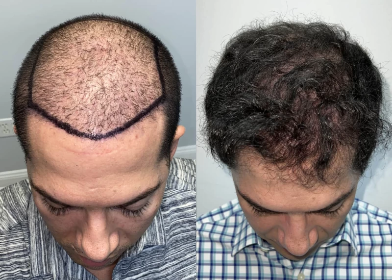 Patient p478 hair transplant before and after tilt view