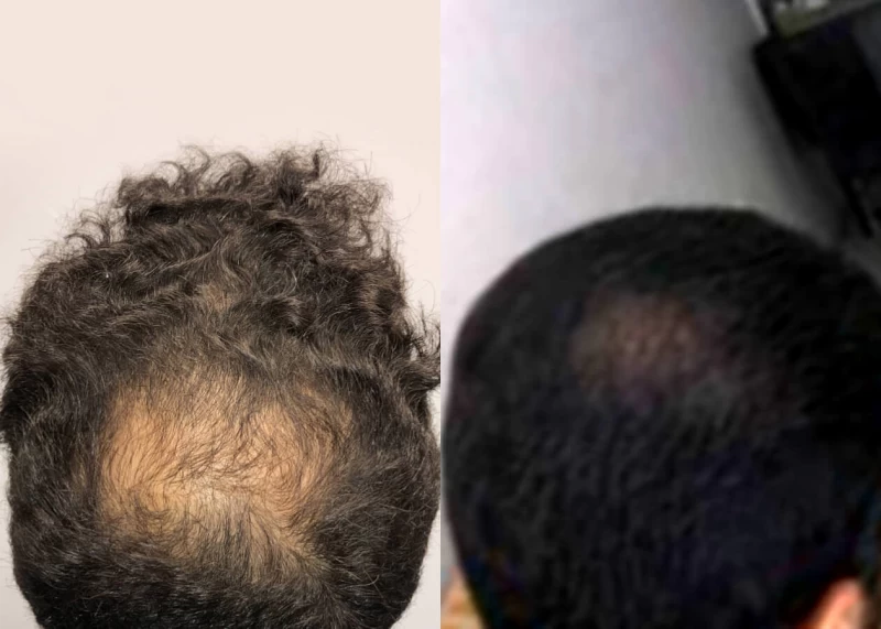 Patient p479 hair transplant before and after crown view