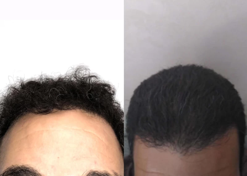 Mr.p479 Hair Transplant Before and After