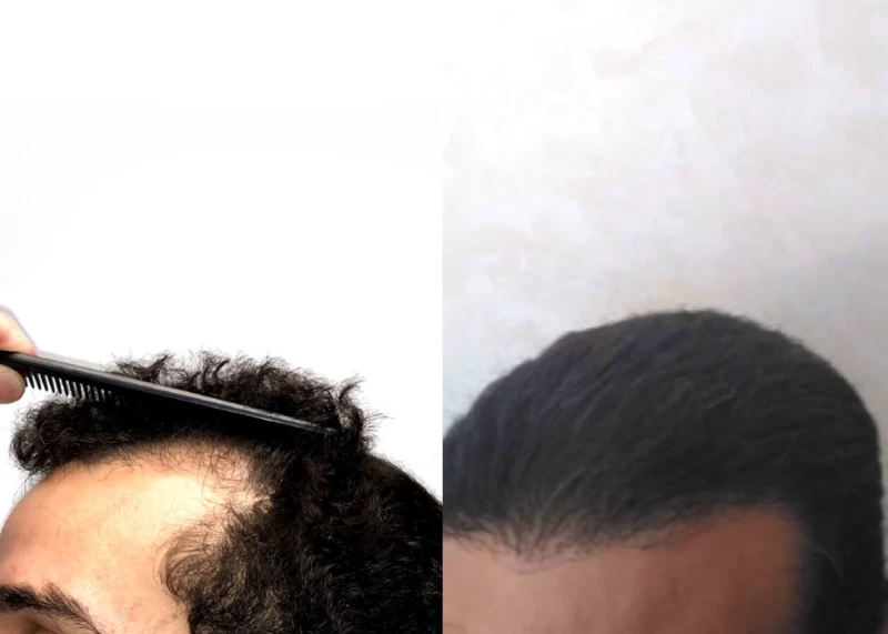 Patient p479 hair transplant before and after left view
