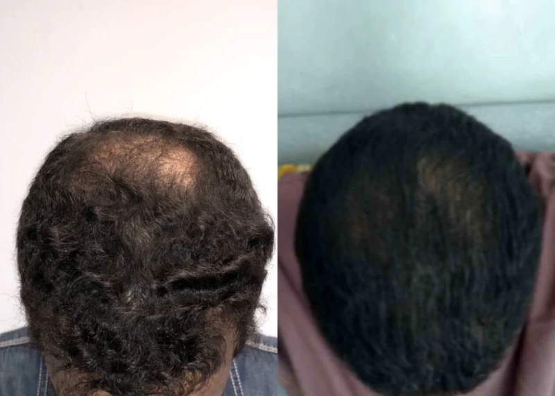 Patient p479 hair transplant before and after tilt view