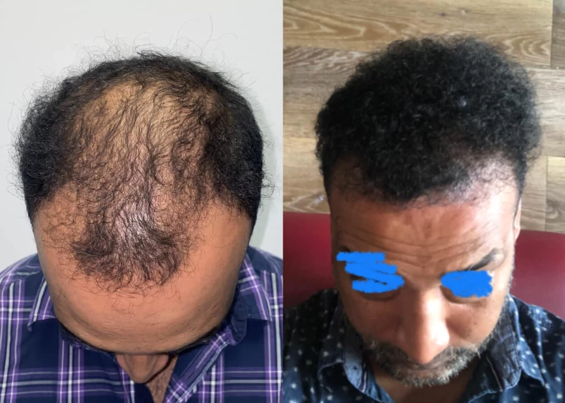 Mr.p480 Hair Transplant Before and After