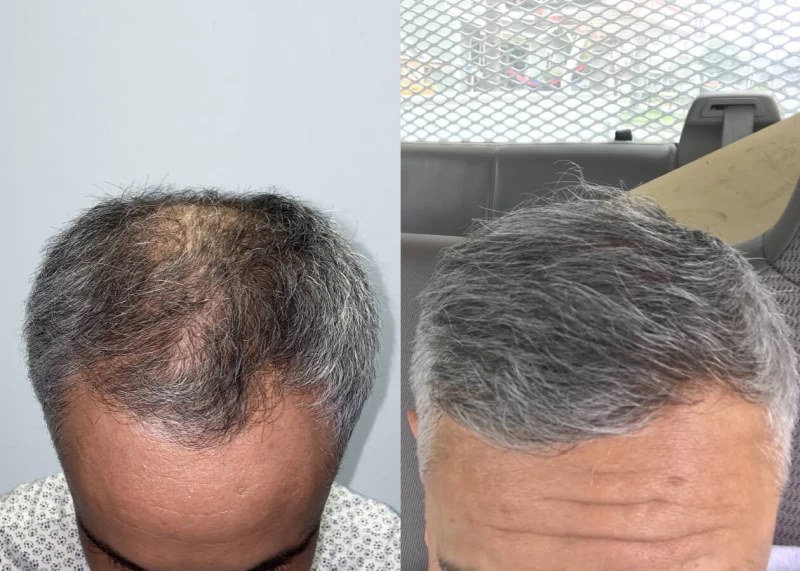 Mr.p481 Hair Transplant Before and After