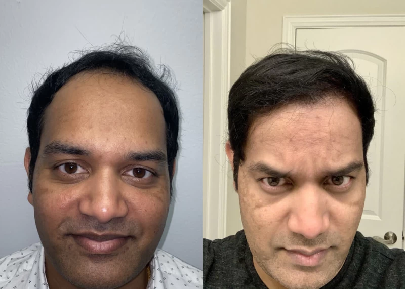 Mr.p482 Hair Transplant Before and After