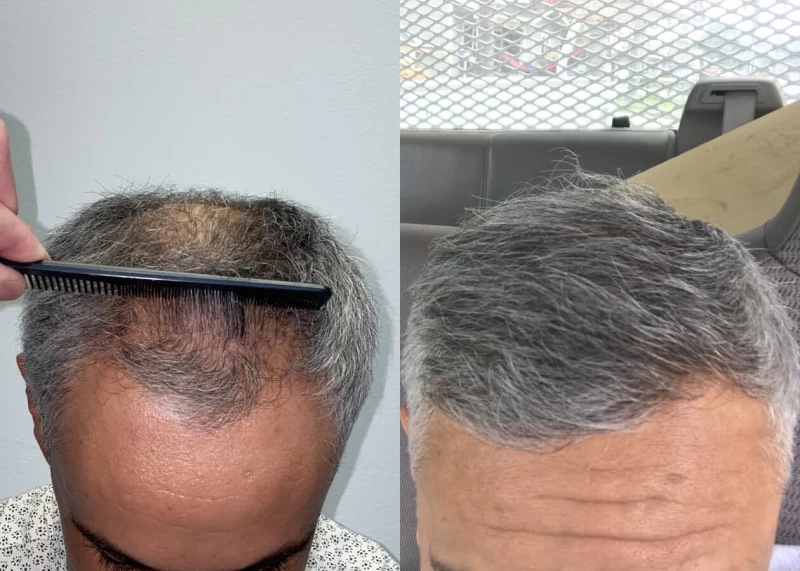 Mr.p483 Hair Transplant Before and After