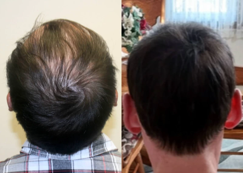 Patient p484 hair transplant before and after crown view