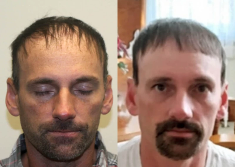 Mr.p484 Hair Transplant Before and After