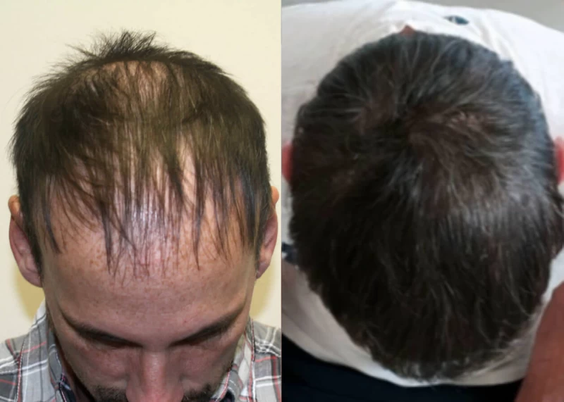 Patient p484 hair transplant before and after tilt view