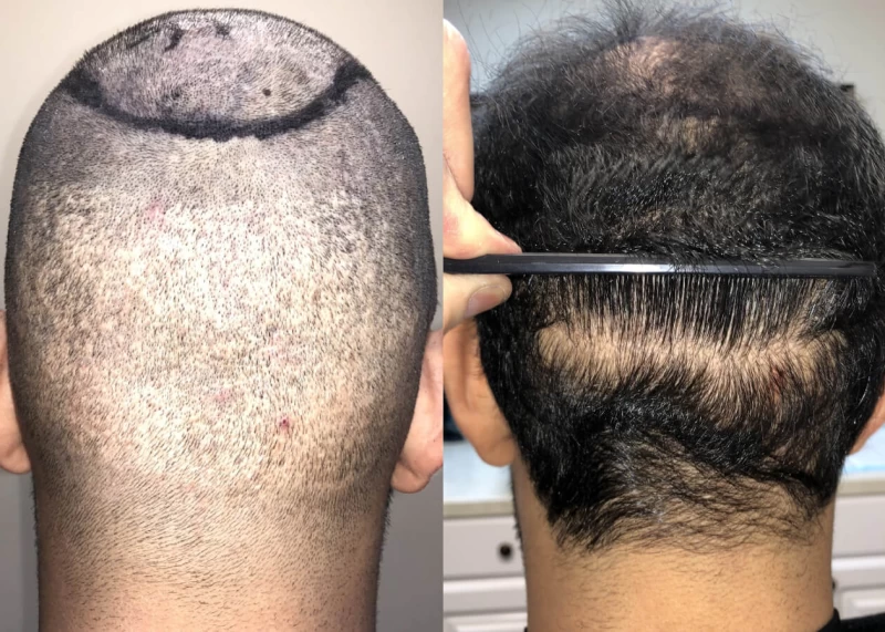 Patient p485 hair transplant before and after crown view