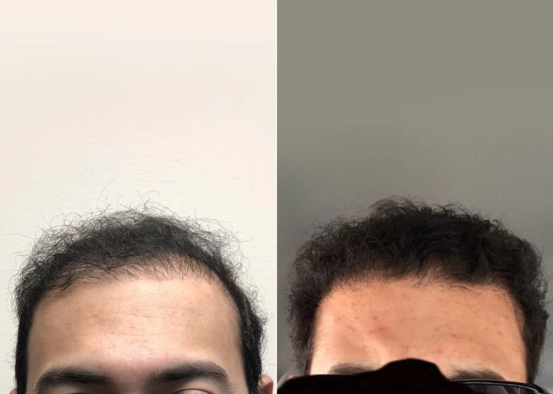 Mr.p485 Hair Transplant Before and After