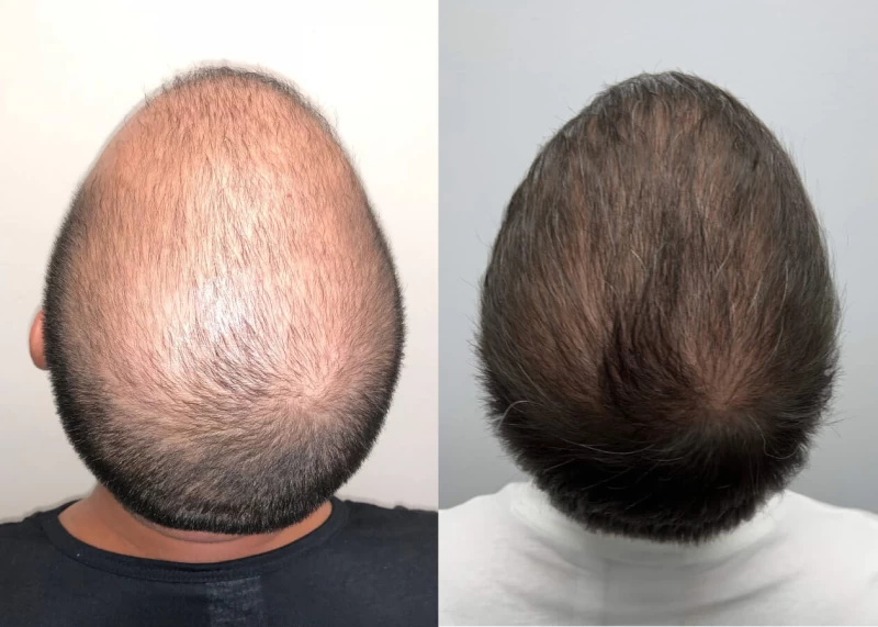 Patient p486 hair transplant before and after crown view