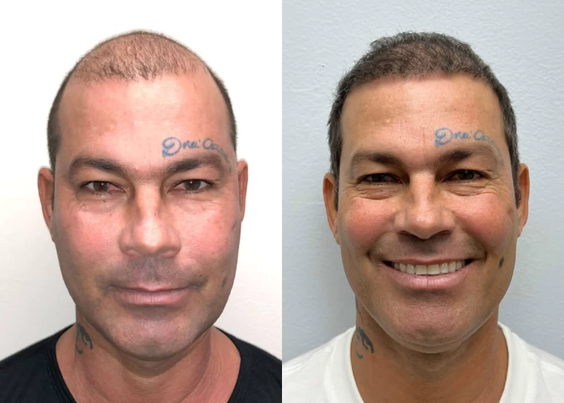 Elcely Hair Transplant Before and After
