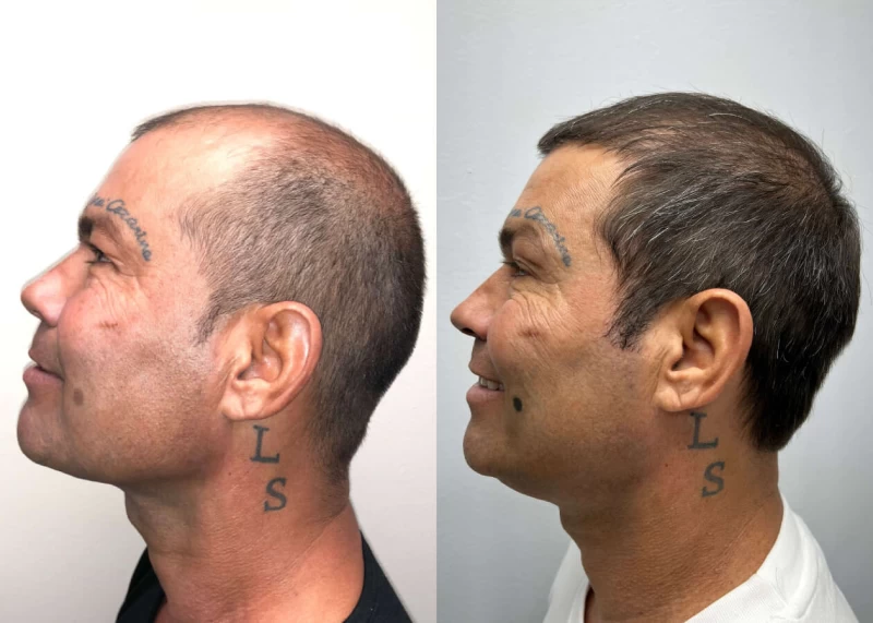Patient p486 hair transplant before and after left view