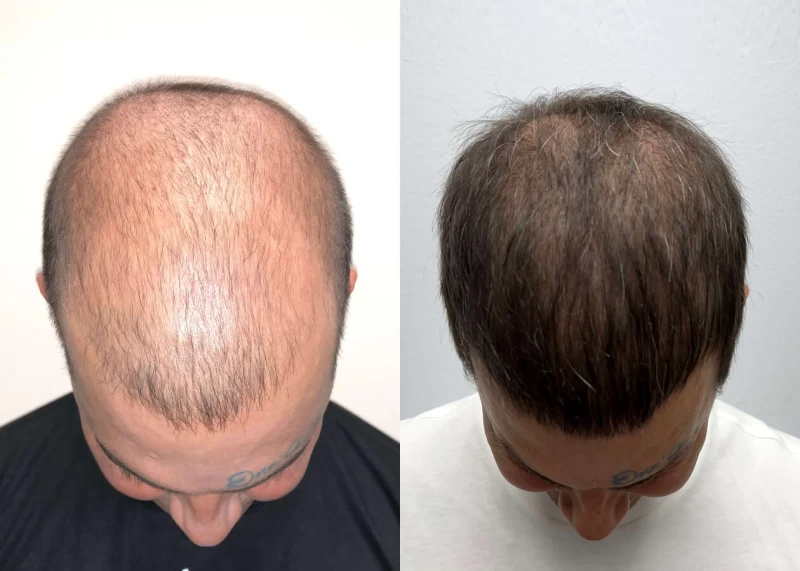 Patient p486 hair transplant before and after tilt view