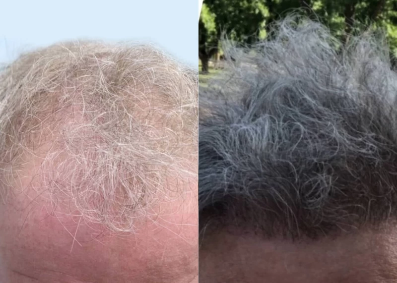 Mr.p487 Hair Transplant Before and After