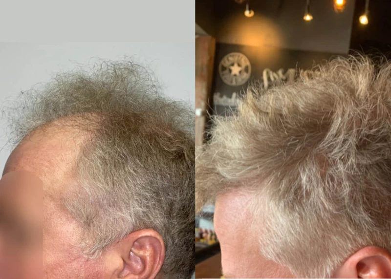 Patient p488 hair transplant before and after left view
