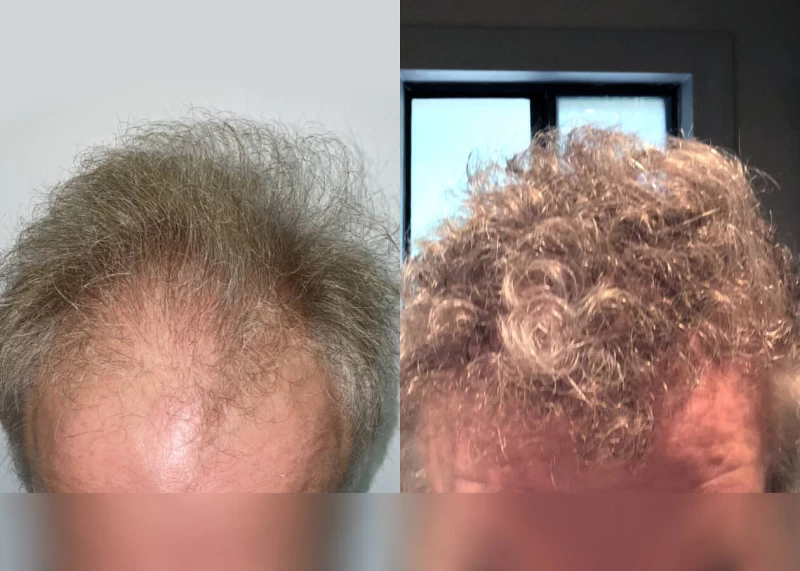 Mr.p488 Hair Transplant Before and After