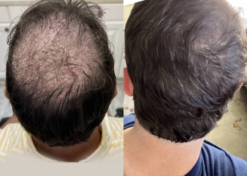 Mr.p489 Hair Transplant Before and After