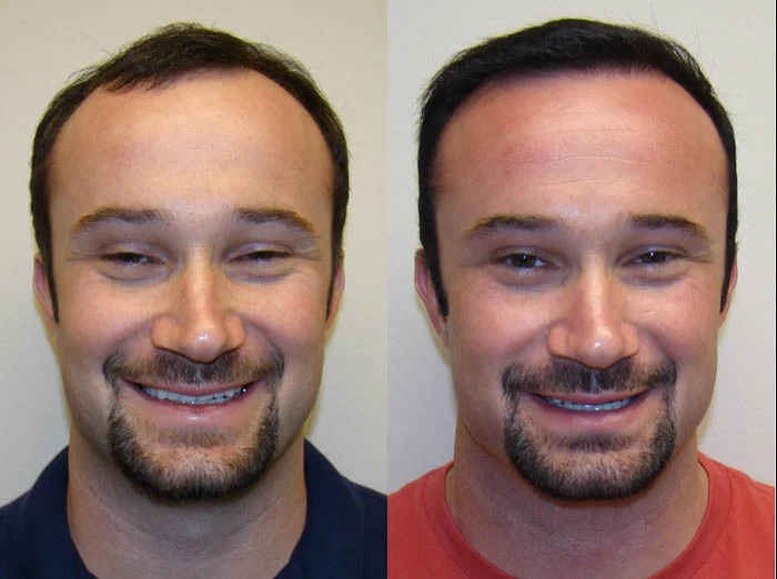 Joel Hair Transplant Before and After