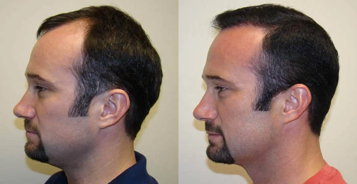 Patient p48 hair transplant before and after left view