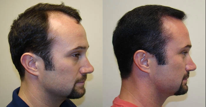 Patient p48 hair transplant before and after right view