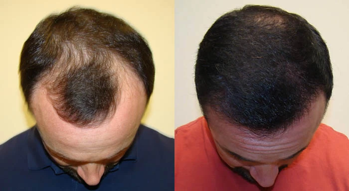 Patient p48 hair transplant before and after tilt view