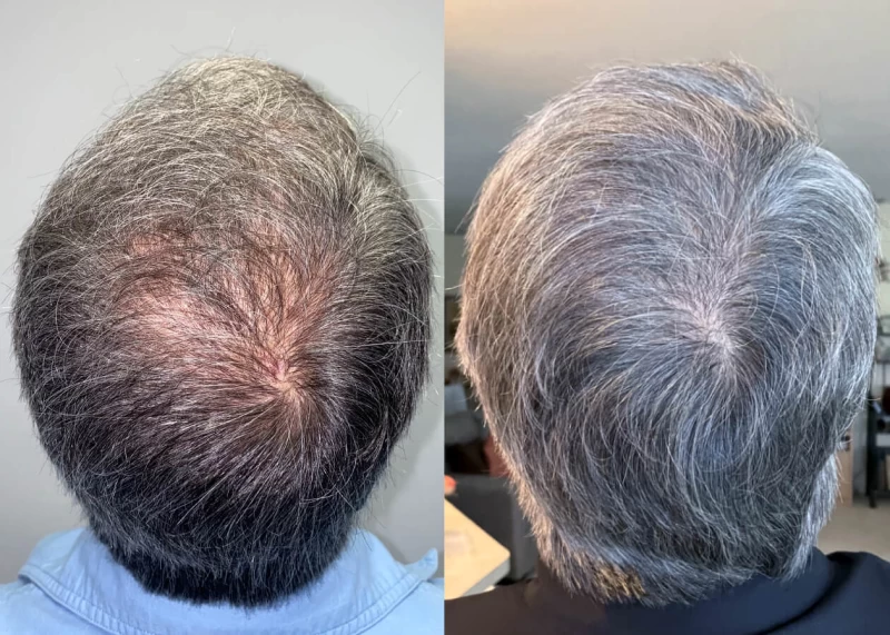 Patient p490 hair transplant before and after crown view