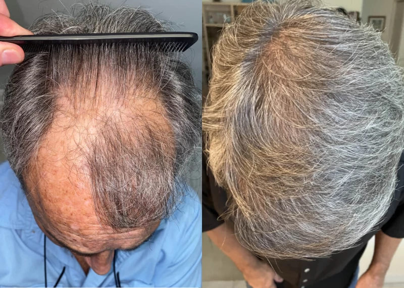 Mr.p490 Hair Transplant Before and After