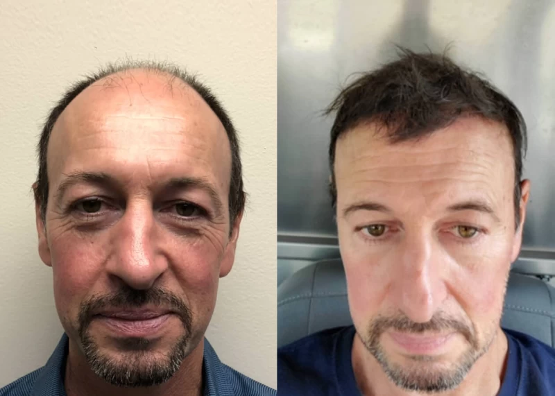 Mr.p491 Hair Transplant Before and After