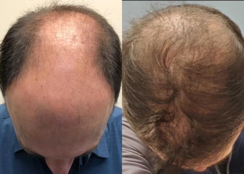 Patient p491 hair transplant before and after tilt view