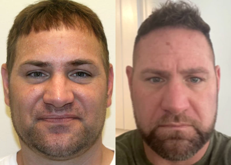 Mr.p492 Hair Transplant Before and After