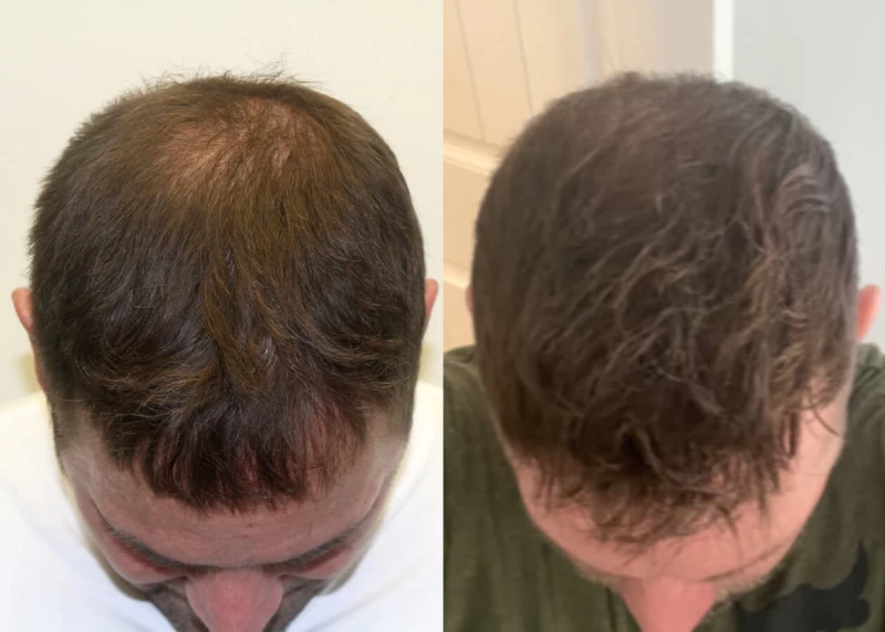 Patient p492 hair transplant before and after tilt view