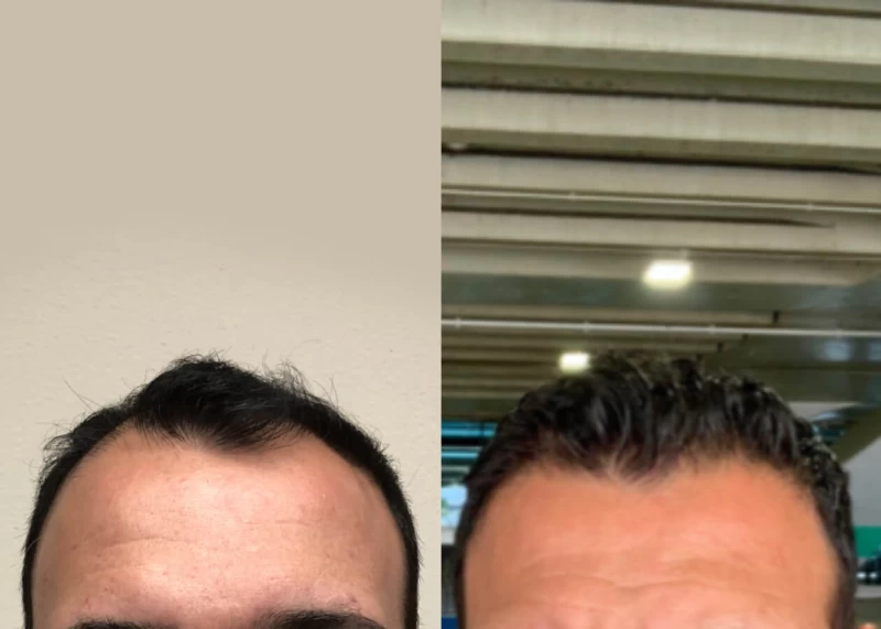 Mr.p493 Hair Transplant Before and After