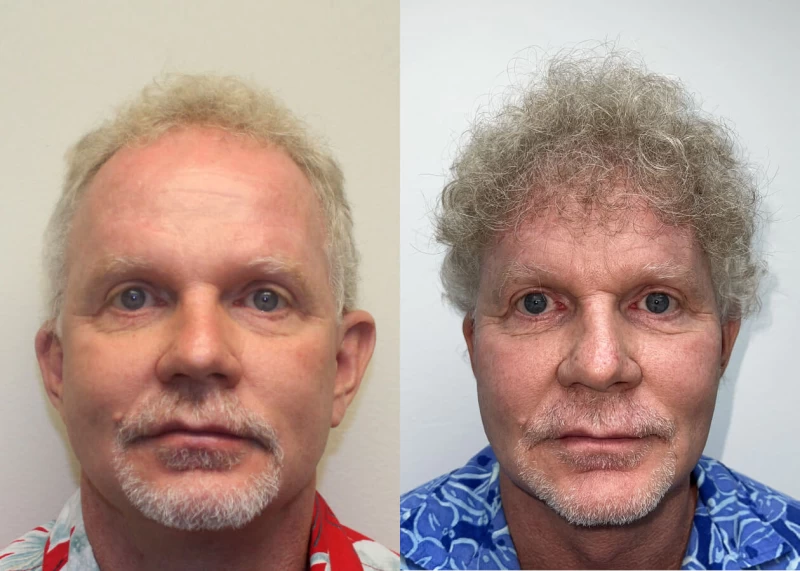Patrick Hair Transplant Before and After