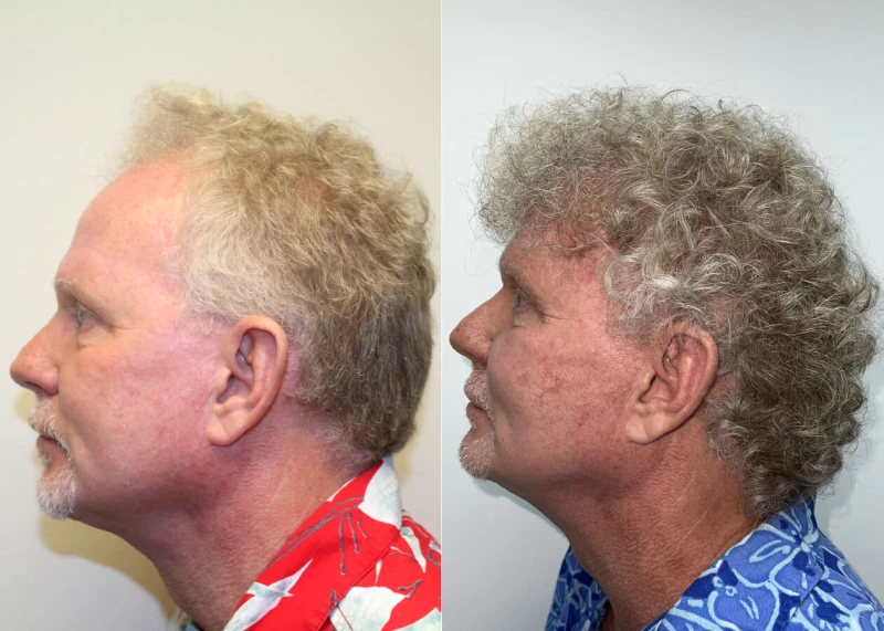 Patient p494 hair transplant before and after left view