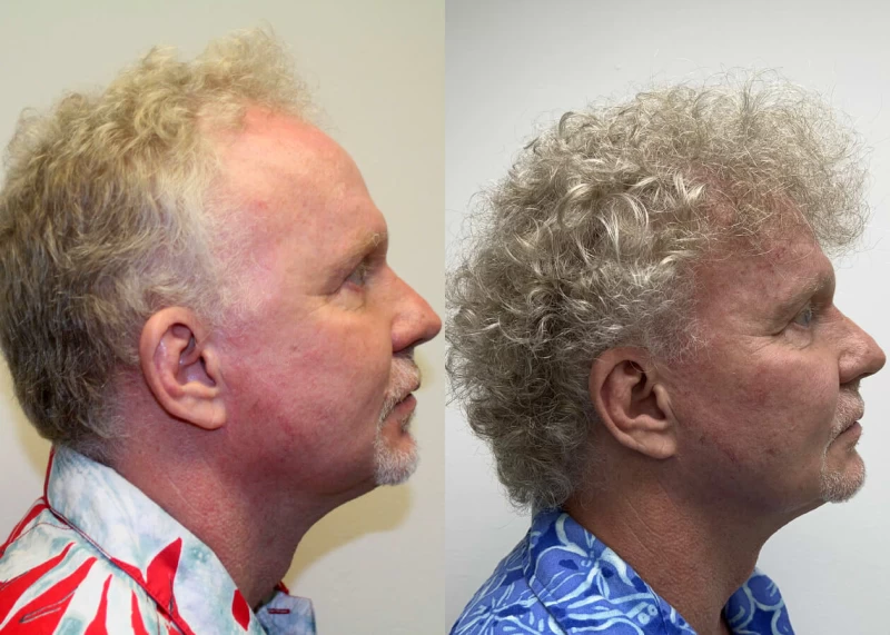 Patient p494 hair transplant before and after right view