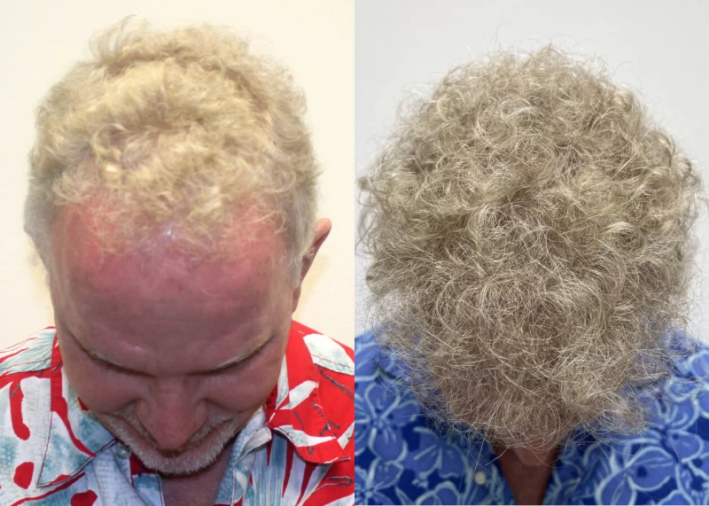 Patient p494 hair transplant before and after tilt view