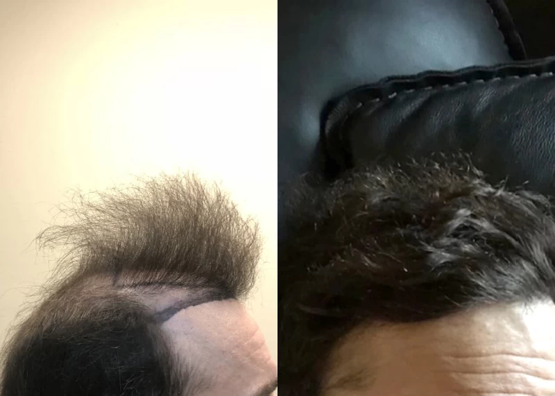 Patient p495 hair transplant before and after right view
