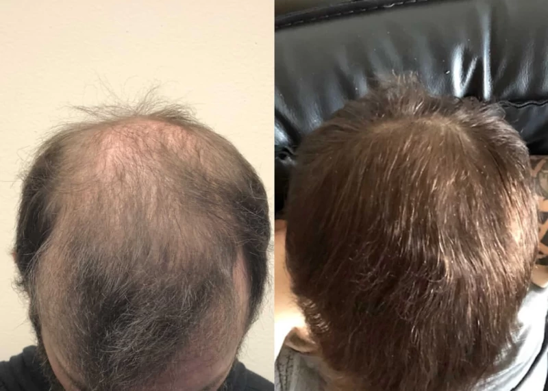 Mr.p495 Hair Transplant Before and After